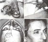 Реконструкции носа